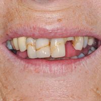 Smile In A Day - Smile 15 before